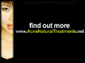 Acne Pimple Naturist Treatment