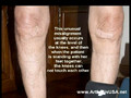 Dr Farshchian s Regenerative Medicine and Bowlegged Knees