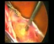 Laparoscopic Hysterectomy | Step 2 | Prof Zion Ben Rafael