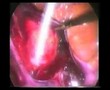 Laparoscopic Hysterectomy | Step 3 | Prof Zion Ben Rafael