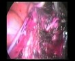 Laparoscopic Hysterectomy | Step 4 | Prof Zion Ben Rafael
