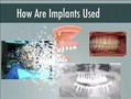Dental Implant Primer