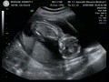 16 Week Ultrasound