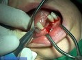 schonende Zahnextraktionen - atraumatic teeth extractions - Piezotome