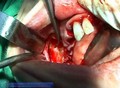 Removal of a big cyst lower jaw - Zysten Operation im Unterkiefer