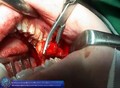 Weisheitszahn Transplantation - Wisdom Tooth Transplantation 