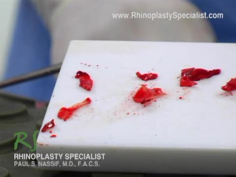 Ethnic Rhinoplasty Nose Surgery : Septoplasty Info