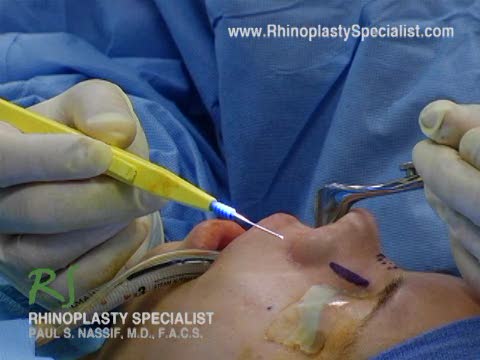 Ethnic Rhinoplasty Nose Surgery : Tubinoplasty Information