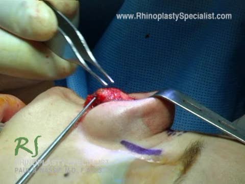 Ethnic Rhinoplasty Nose Surgery : Soft Tissue Removal