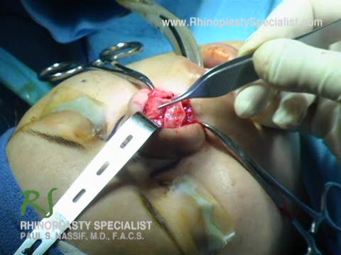 Ethnic Rhinoplasty Nose Surgery :  Tip Cartilage Contouring