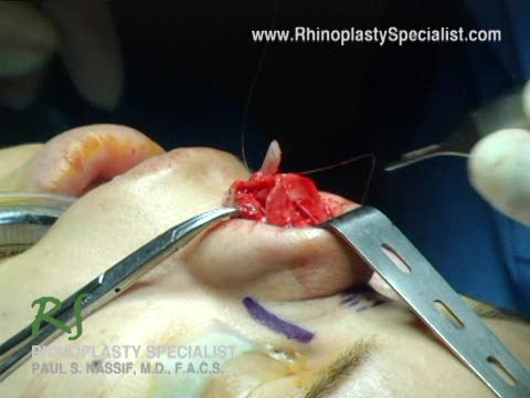 Ethnic Rhinoplasty Nose Surgery :  Columella Strut Placement