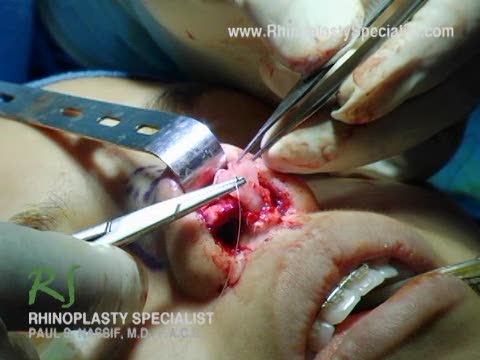Ethnic Rhinoplasty Nose Surgery :  Shield & Rim Grafts