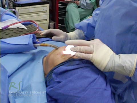 Nose Surgery Turbinate Reduction Closed Rhinoplasty Scarless