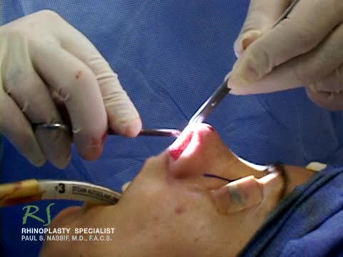 Nose Surgery Exposing Nasal Skeleton  - Closed Rhinoplasty