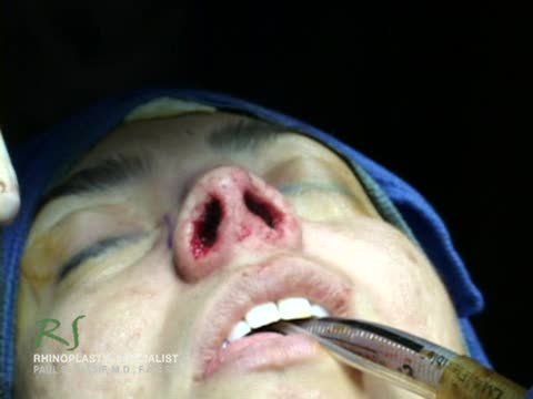 Nose Surgery Spreader Grafts  - Closed Rhinoplasty