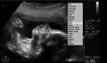 Baby Ultrasound - 23 June 2009