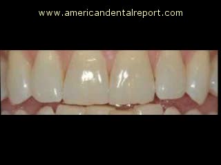Teeth Whitening Time Lapse