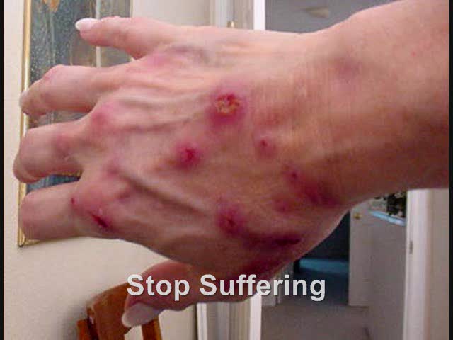 Morgellons Cure! - FREE Sample - (832) 343-5425