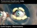 Plastic eyelid surgery- Fair cost prices for Plastic eyelid surgery in India