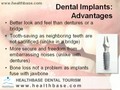 Dental Implants Guide - Healthbase - Dental Travel