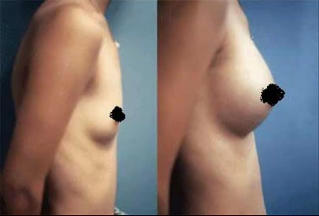 Breast Implants Before After