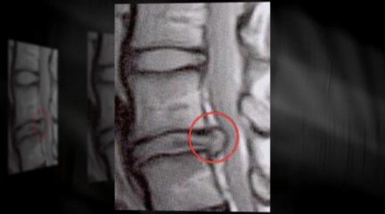 Cary Is Your Daily Life Affected By A Bulged Disc?
