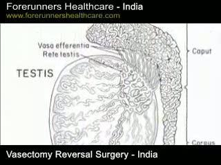 Get Vasectomy Reversal Surgery in India at a Cost Effective Price!