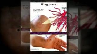 ringworm treatment