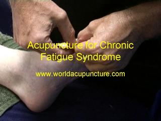Acupuncture for Chronic Fatigue Syndrome