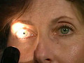 Cranial Nerves II & III - Pupillary Light Reflex 5/25