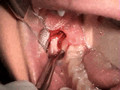 Surgical Removal Of a Wisdom Tooth