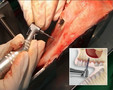 INTRALIFT - Surgical Protocol and demo on sheep head