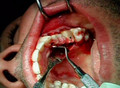 ULTRASONIC SURGERY - periodontal surgery procedure with an ultrasonic device