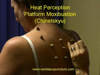 Acupuncture /Moxibustion.wmv