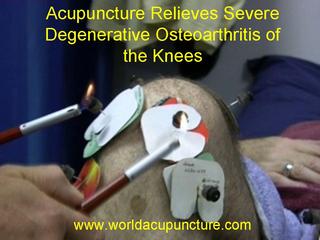 Acupuncture Relieves Severe Arthritis