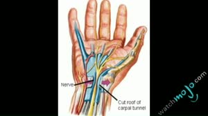 Video on Carpal Tunnel Syndrome
